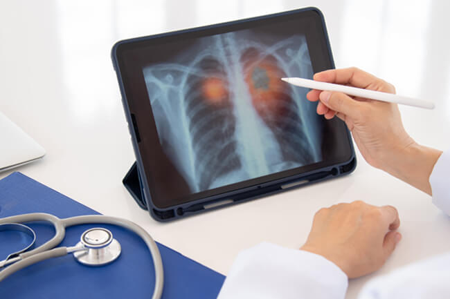 COPD